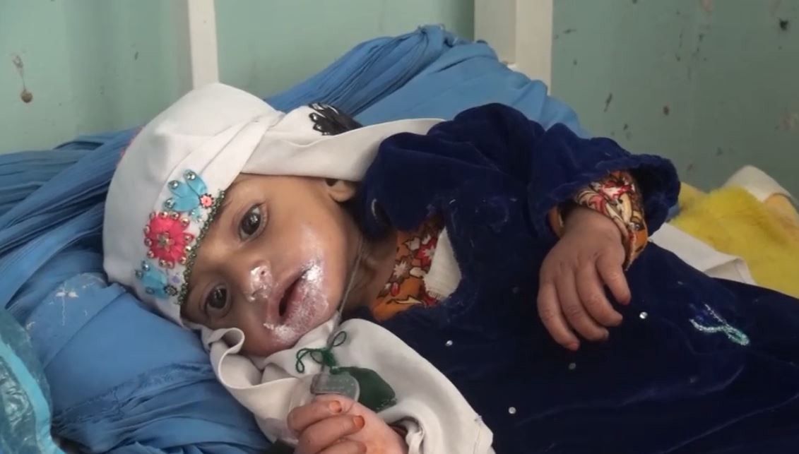 Infant Malnutrition Overwhelms Afghan Hospitals